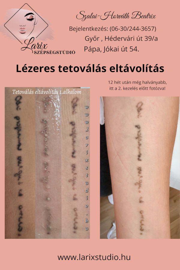 Larix Szépségstúdió Pápa Tetoválás eltávolítása